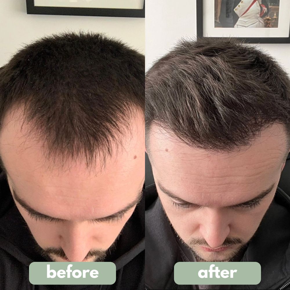 Hair Growth Serum